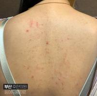 치료 전