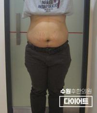 치료 전