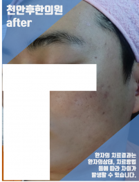 치료 후