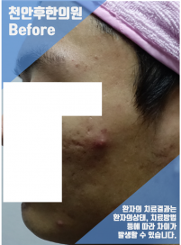치료 전