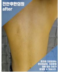 치료 후