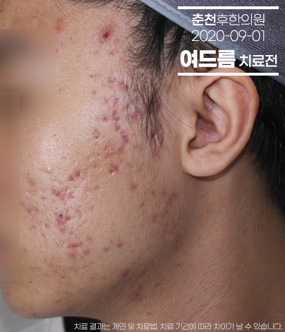 치료 전