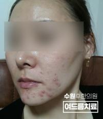 치료 전