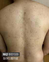 치료 전