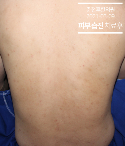 치료 후