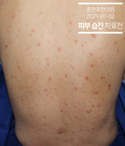치료 전