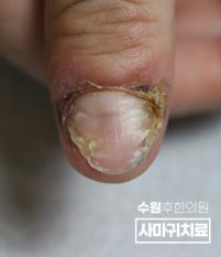 치료 전