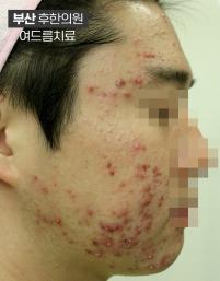 치료 전