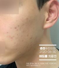 치료 전