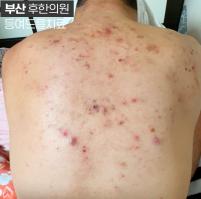 치료 전