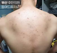 치료 후