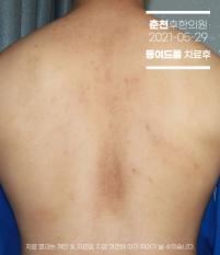 치료 후