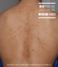 치료 전