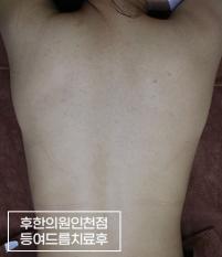 치료 후