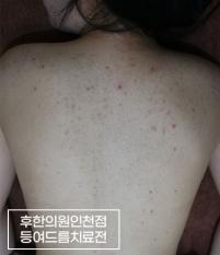 치료 전