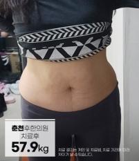 치료 후