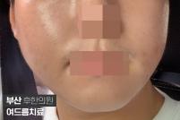 치료 후