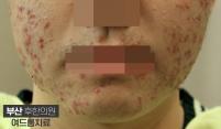 치료 전
