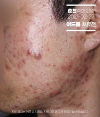 치료 전