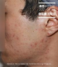 치료 후