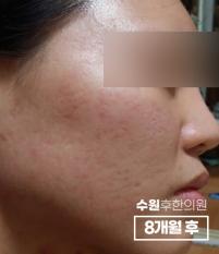 치료 후
