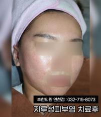 치료 후