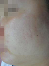 치료 전