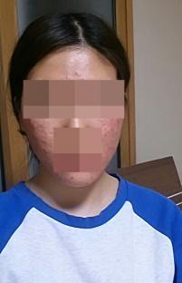 치료 전