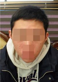 치료 전