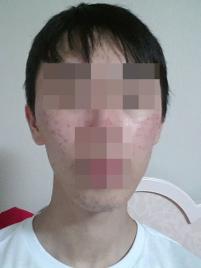 치료 전