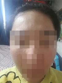 치료 후