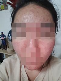 치료 전
