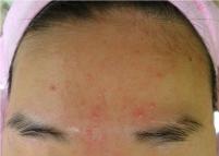 치료 전