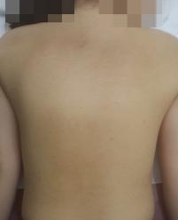 치료 후