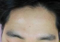 치료 후