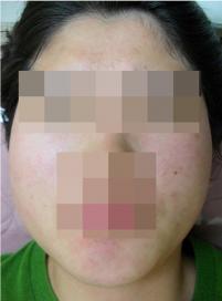 치료 후