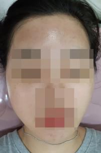 치료 후