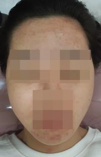 치료 전