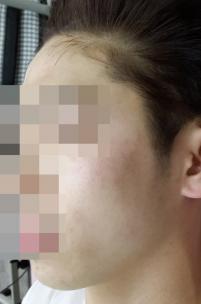 치료 후
