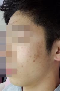 치료 전