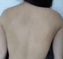 치료 후