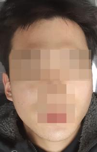치료 후