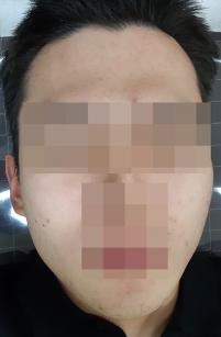 치료 전