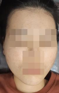치료 후