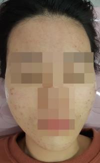 치료 전