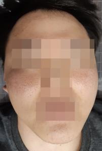 치료 후