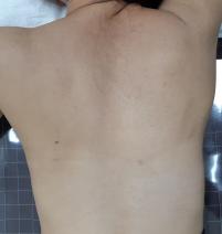 치료 후