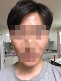 치료 후
