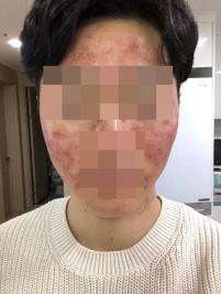 치료 전