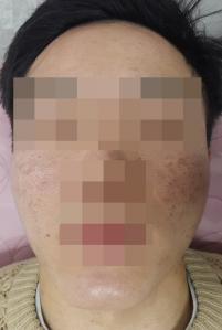 치료 전